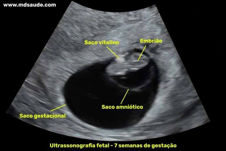 Feto De 7 Semanas De Gestacion Fotos www.mdsaude.com