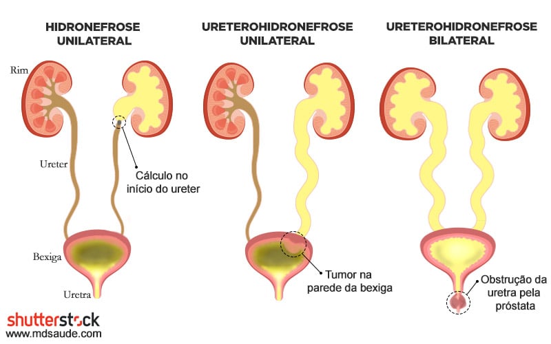 Diferentes causas de hidronefrose