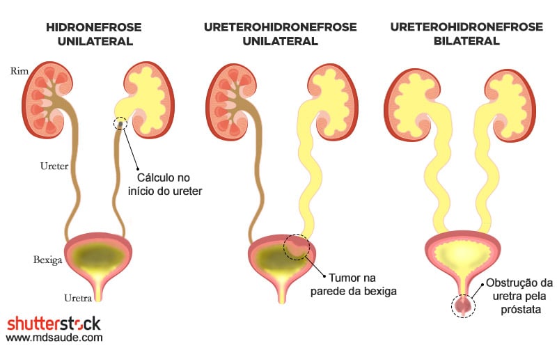 hidronefrose