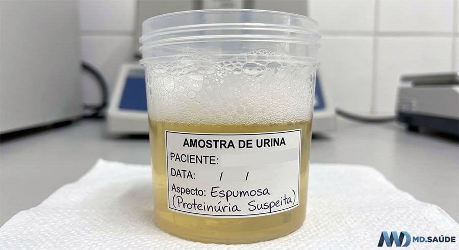 Urina espumosa