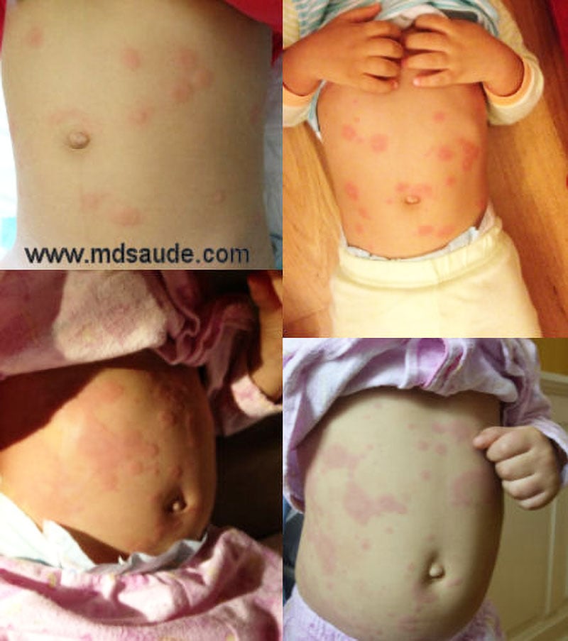 Urticaria em criança