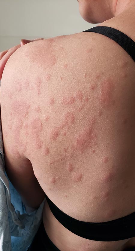 Urticaria en la espalda y los hombros