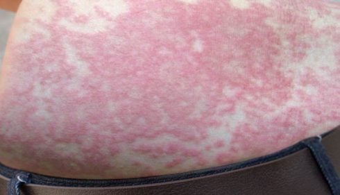 Urticaria en la piel: qué es, síntomas y tratamiento