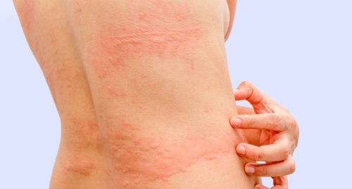 Fotos de urticaria (alergia en la piel)