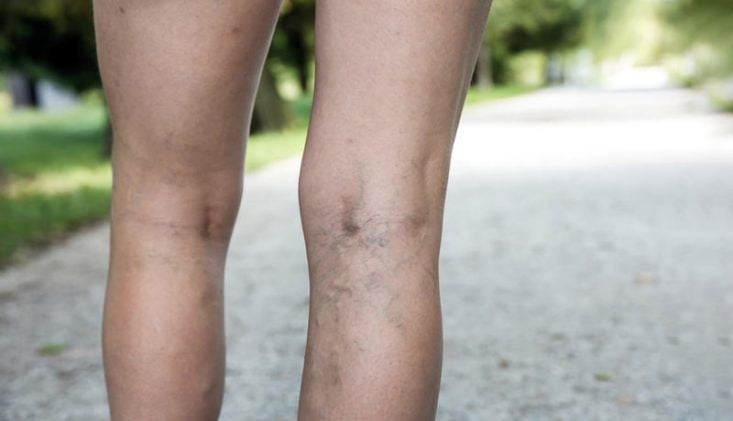 Varices en las piernas: causas, síntomas y tratamiento