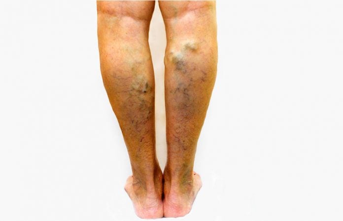 Insuficiencia venosa crónica: sequedad y oscurecimiento de la piel