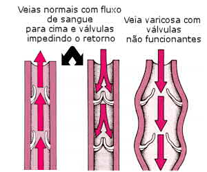 VARIZES - Causas, graus, sintomas e tratamento 2 varizes