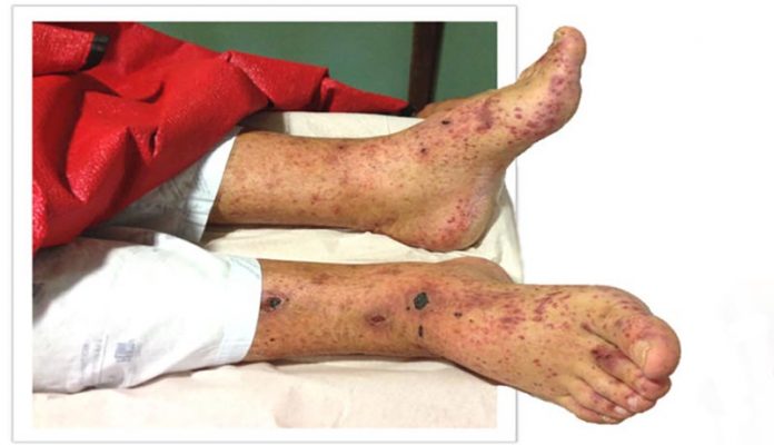 vasculite-imagem Vasculite nos membros inferiores