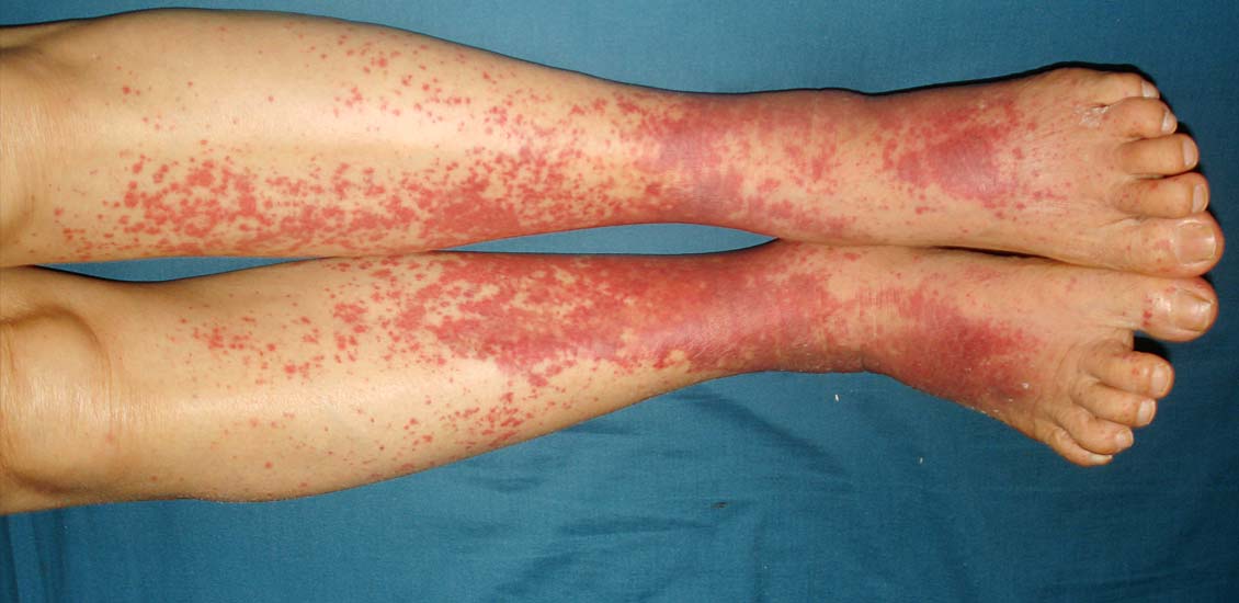 Vasculitis tratamiento natural