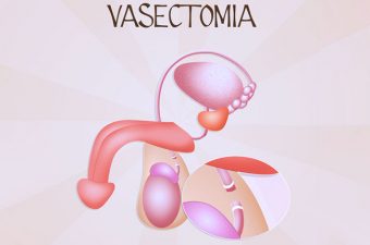 VASECTOMIA – O que é, como é feita e possibilidade de reversão