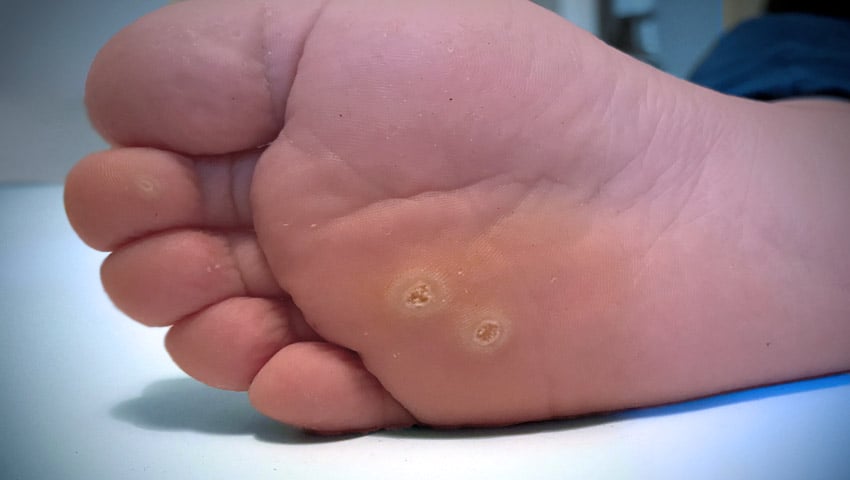 Wart on foot with black spots - zsazsazsu.ro Wart treatment toe