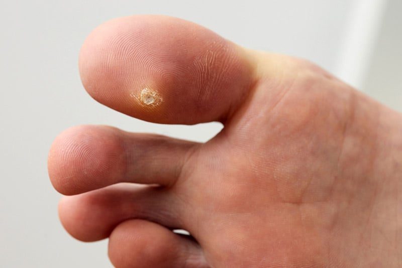 Verruga no dedo do pé