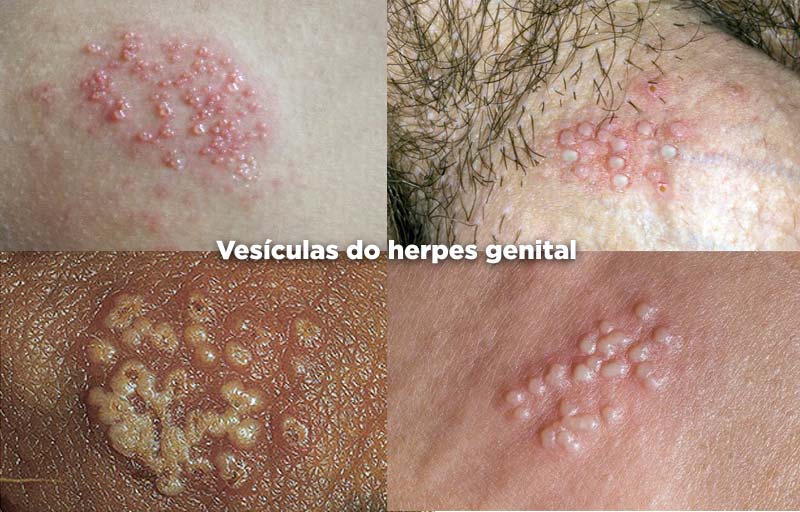 Bolhas do herpes genital