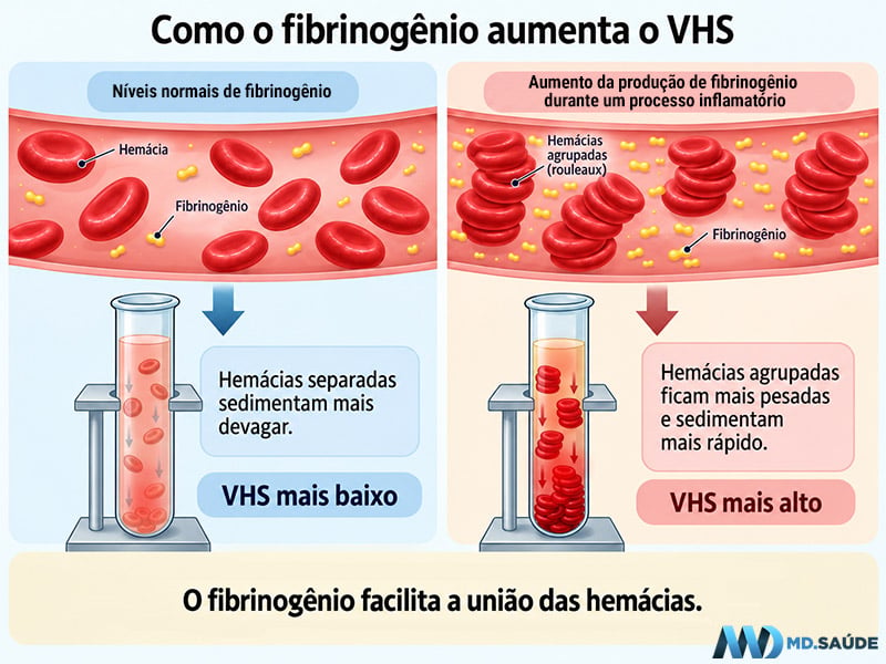 Ilustração comparando o VHS normal e elevado. À esquerda, hemácias separadas sedimentam lentamente; à direita, o aumento do fibrinogênio favorece a formação de agrupamentos de hemácias (rouleaux), que sedimentam mais rapidamente.