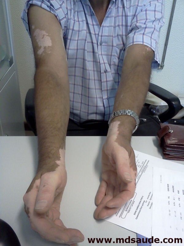 Vitiligo nas mãos e braços Vitiligo nas mãos e braços