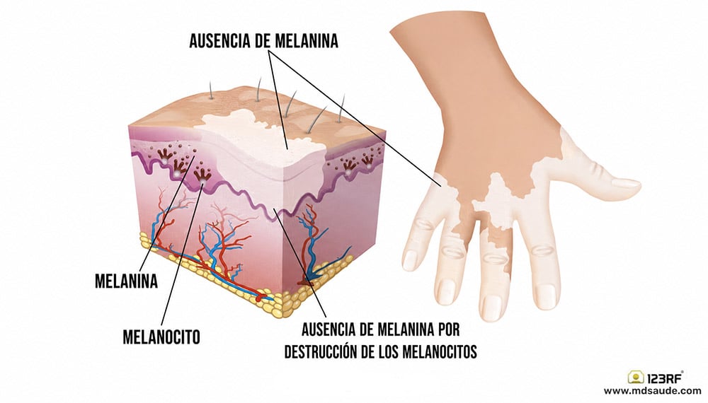Cómo surge el vitiligo