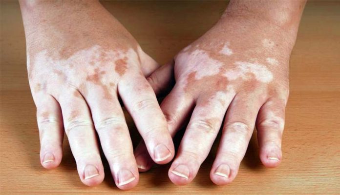 vitiligo-imagem vitiligo